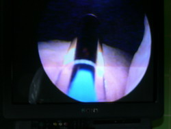 laserowe zabiegi urologiczne